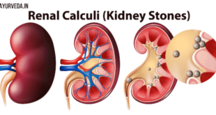 पथरी के घरेलू उपचार: Home Remedies that help with kidney stones