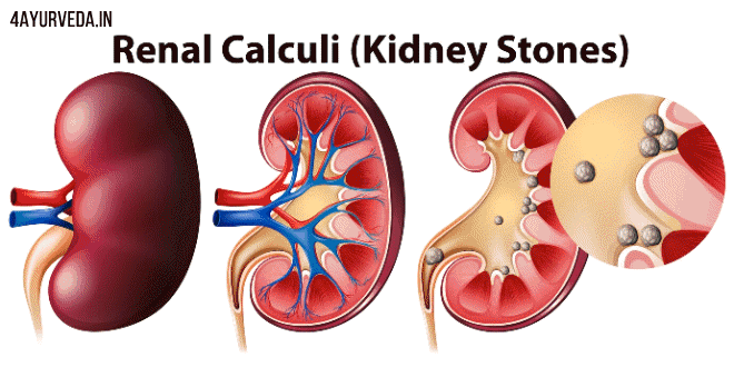पथरी के घरेलू उपचार: Home Remedies that help with kidney stones