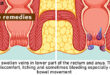 Home remedies for Piles