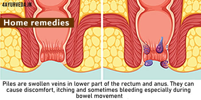 Home remedies for Piles